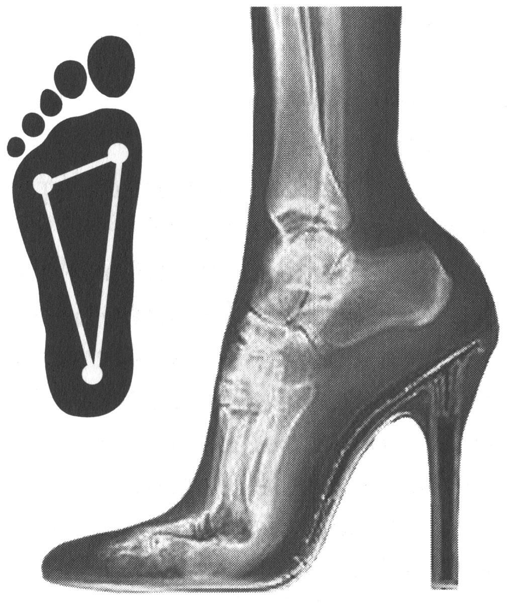 Нагрузка на опорные точки стопы при использовании обуви на высоком каблуке