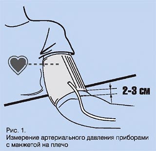 Правильное расположение манжеты тонометра на руке